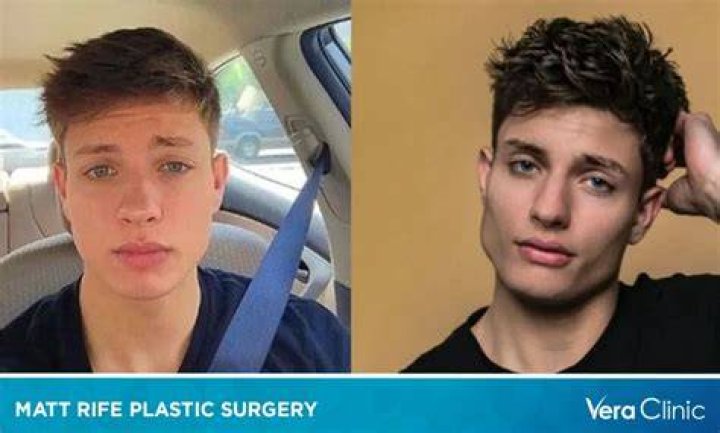 Matt Rife’s Plastic Surgery Check Out His Before and After Pictures